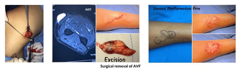 AVM overview