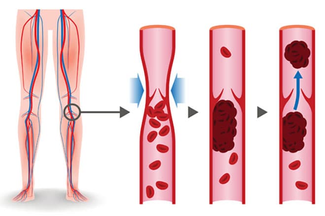 Deep Vein Thrombosis The Vascular Endovascular Clinic