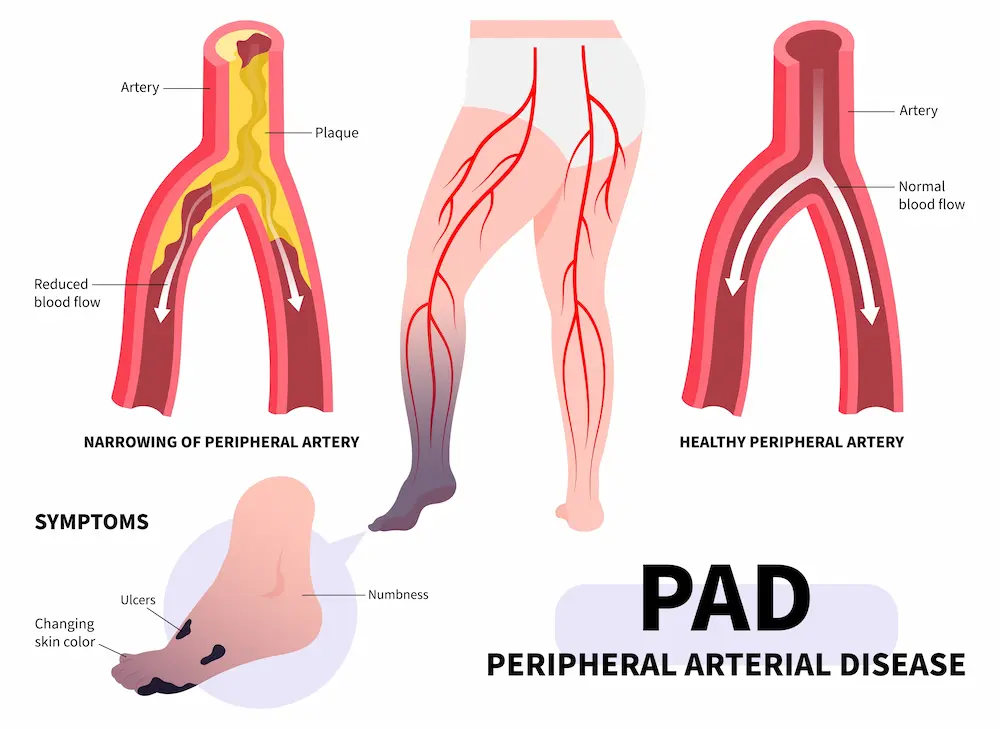 Illustration of PAD symptoms in the feet