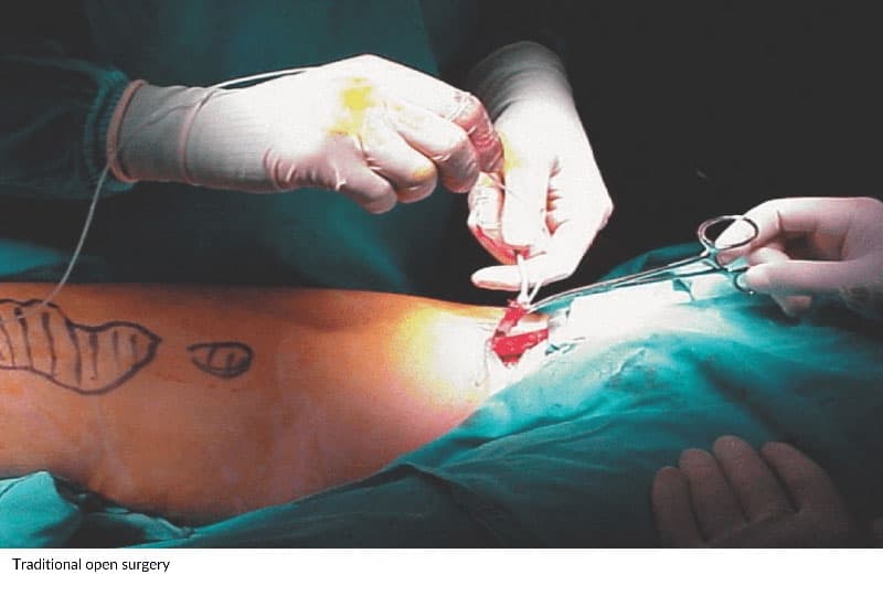 Traditional Open Surgery