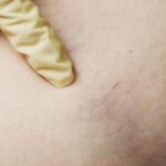 Understanding Your Vein Health