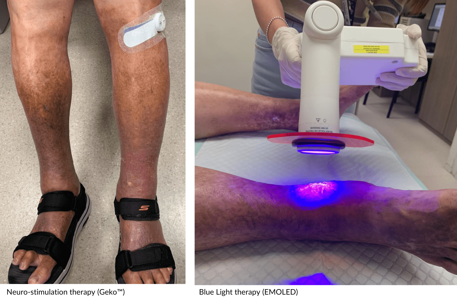 Neurostimulation Therapy & Blue Light Therapy