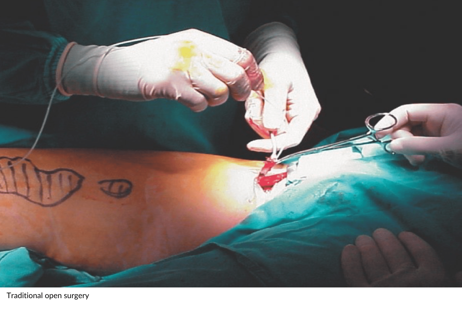 Traditional open surgery for varicose veins