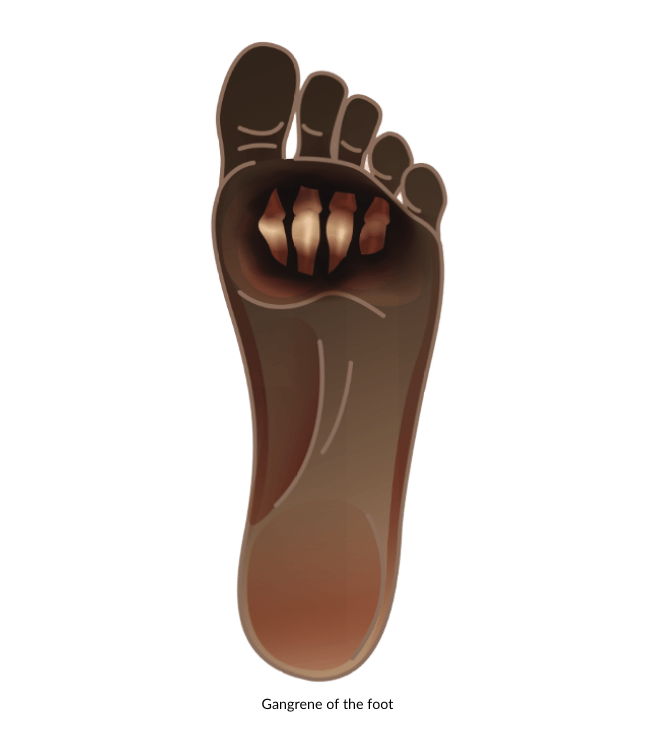 Gangrene Of The Foot