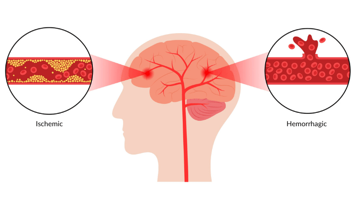 Ischemic