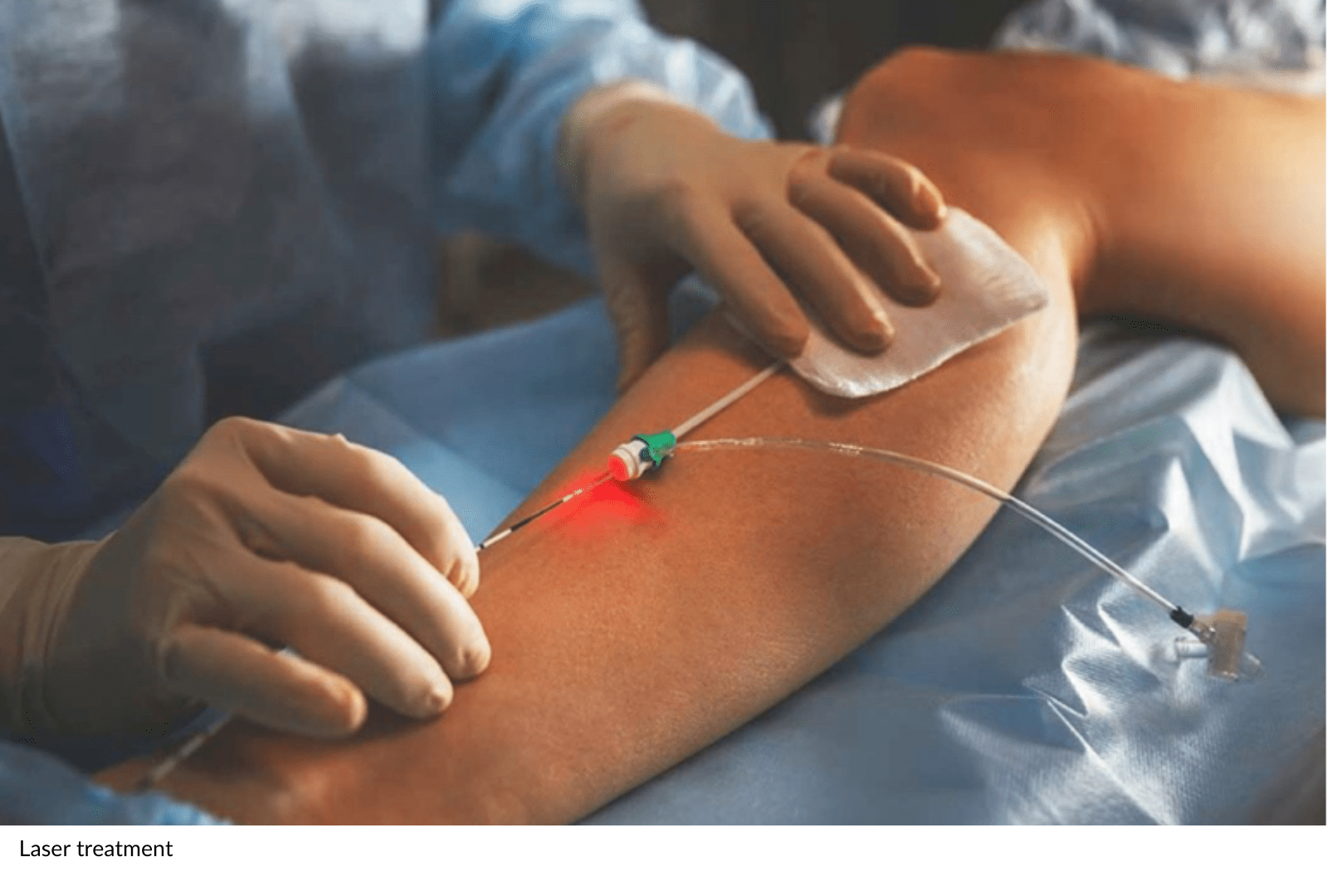 Laser Treatment Varicose Veins