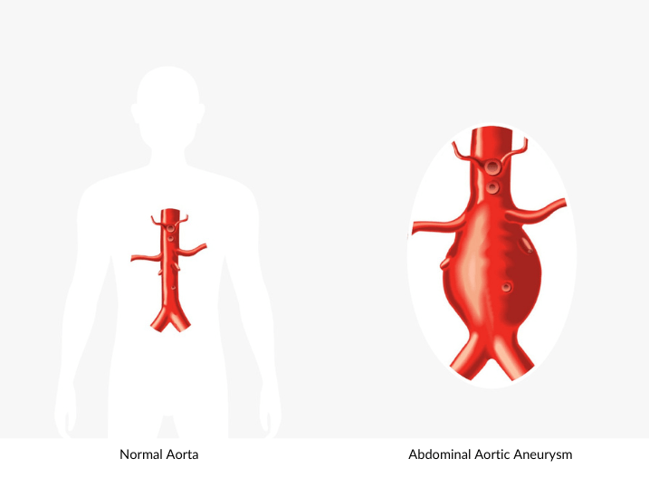 Normal Aorta