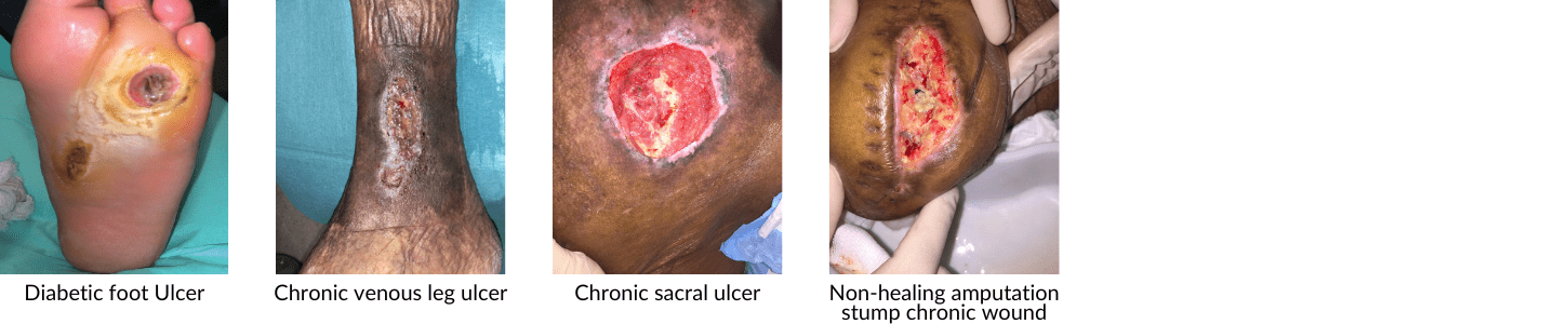 Wounds Ulcer