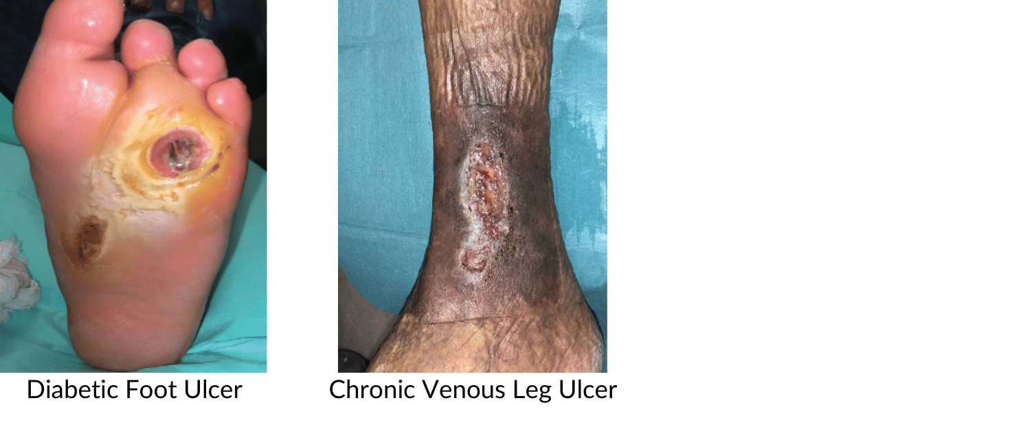 Diabetic Foot Ulcer / Chronic Venous Leg Ulcer