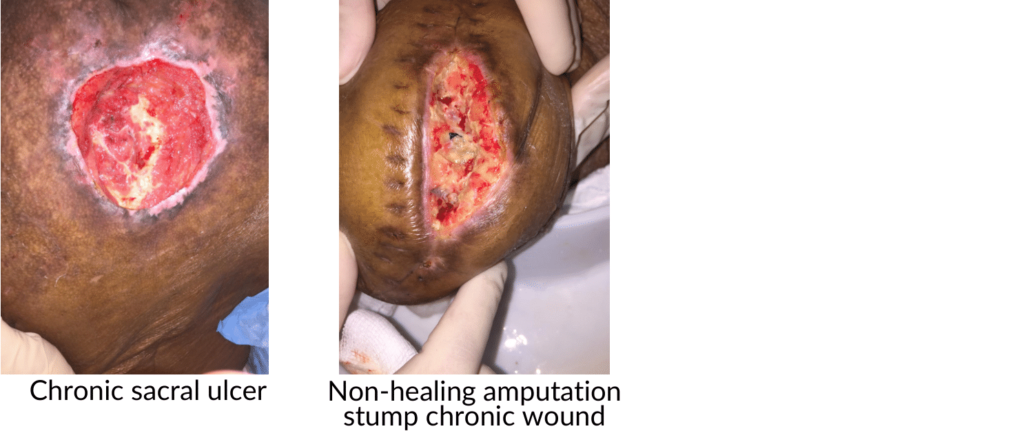 Chronic Sacral Ulcer / Non-Healing Amputation Stump Chronic Wounds