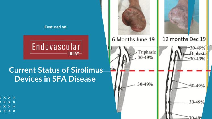 Current Status Of Sirolimus Devicesc In SFA Disease