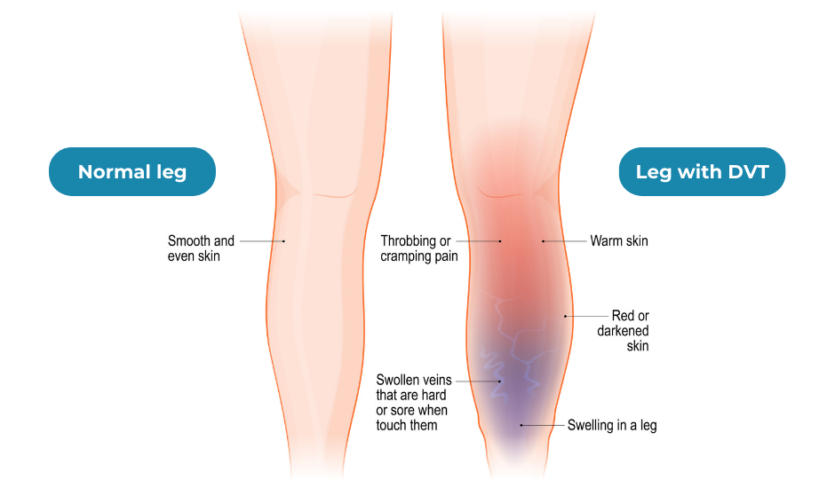 The Causes And Symptoms Of Deep Vein Thrombosis Dvt