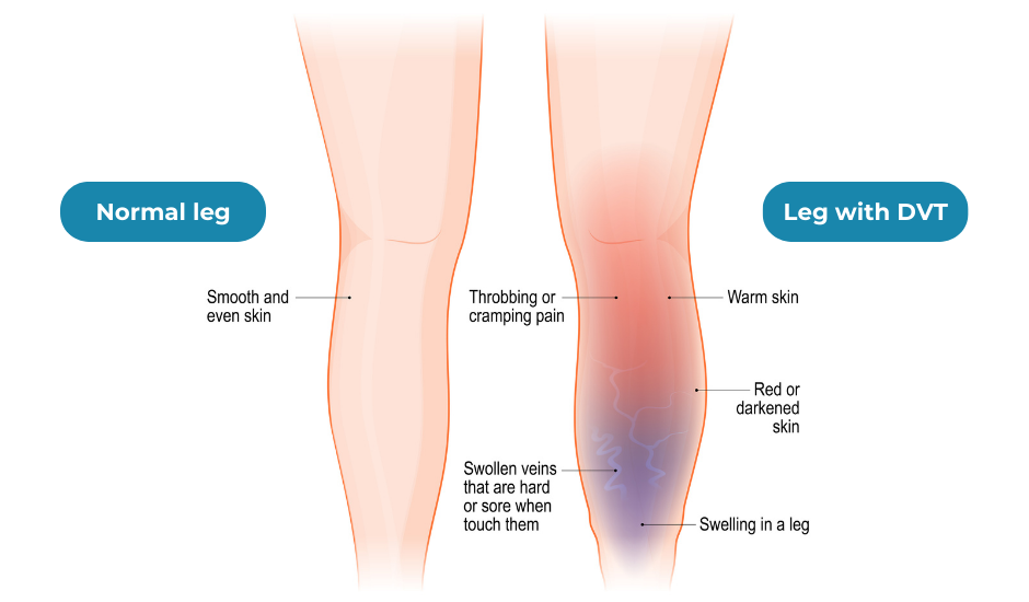 The Causes And Symptoms Of Deep Vein Thrombosis DVT 