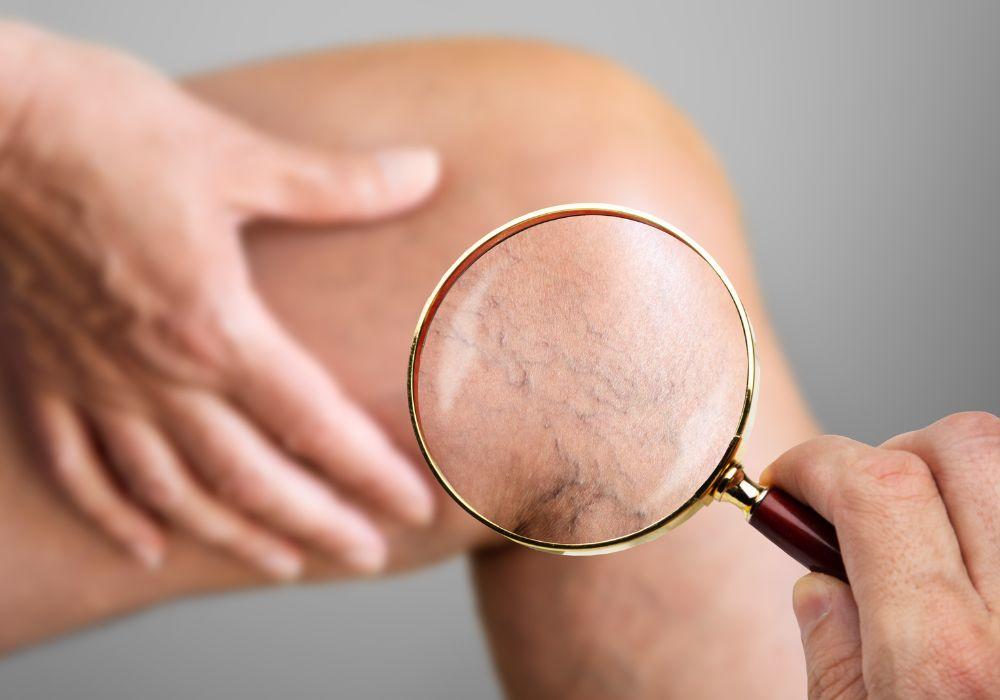 How to Cure & Prevent Spider Veins on the Legs