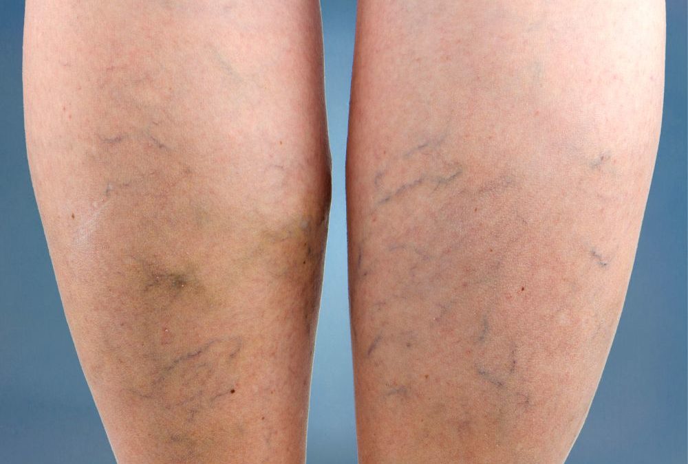 Varicose Veins – Symptoms, Causes, and Treatment