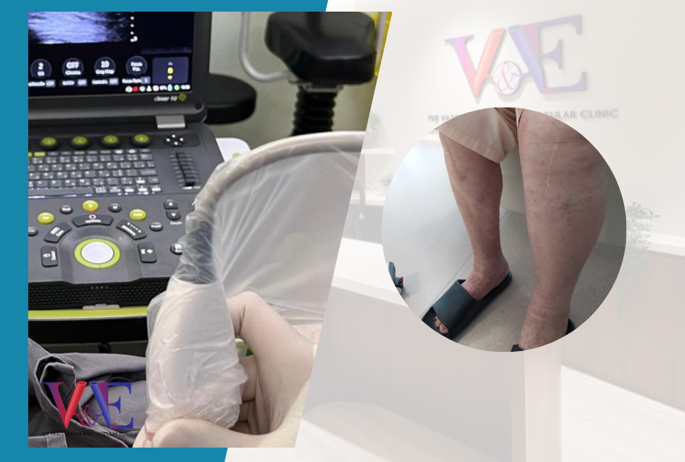 One Stop Deep Vein Thrombosis (DVT) Service at The VEC