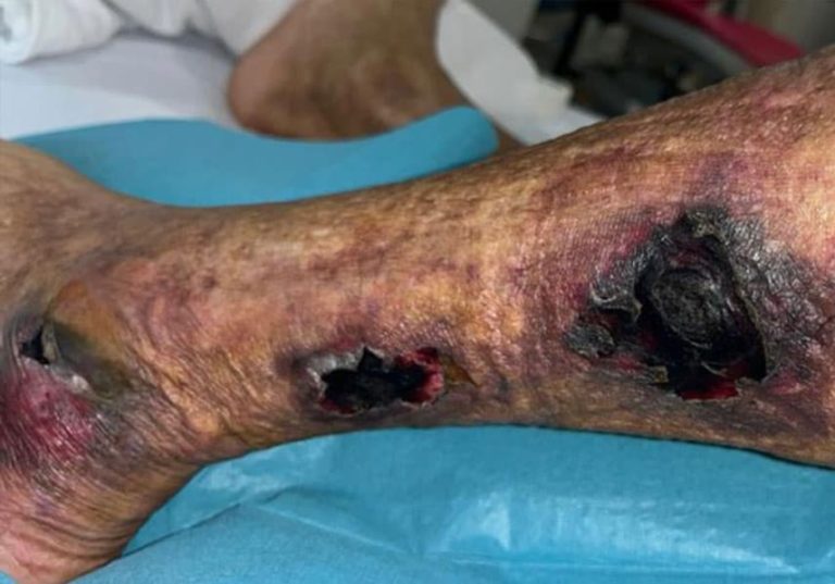 Diabetic Foot Ulcers