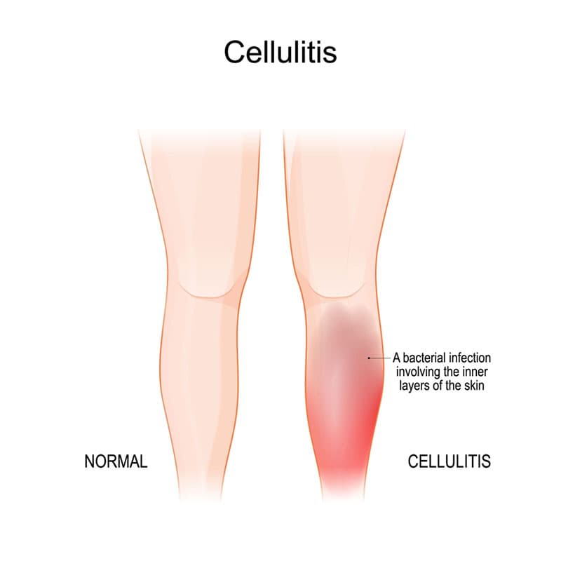 cellulitis diagram