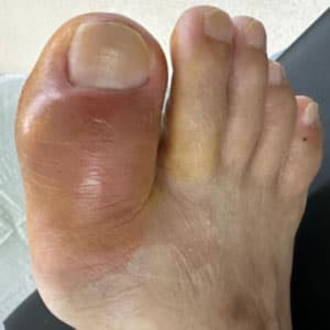 Understanding Diabetic Foot Ulcers: Symptoms, Signs, and Early ...