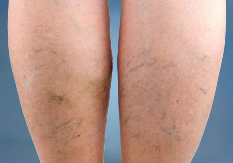 varicose veins
