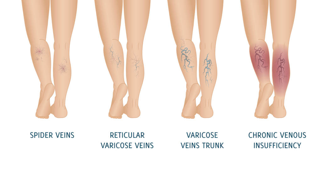 Managing Chronic Venous Insufficiency: Symptoms At Every Stage