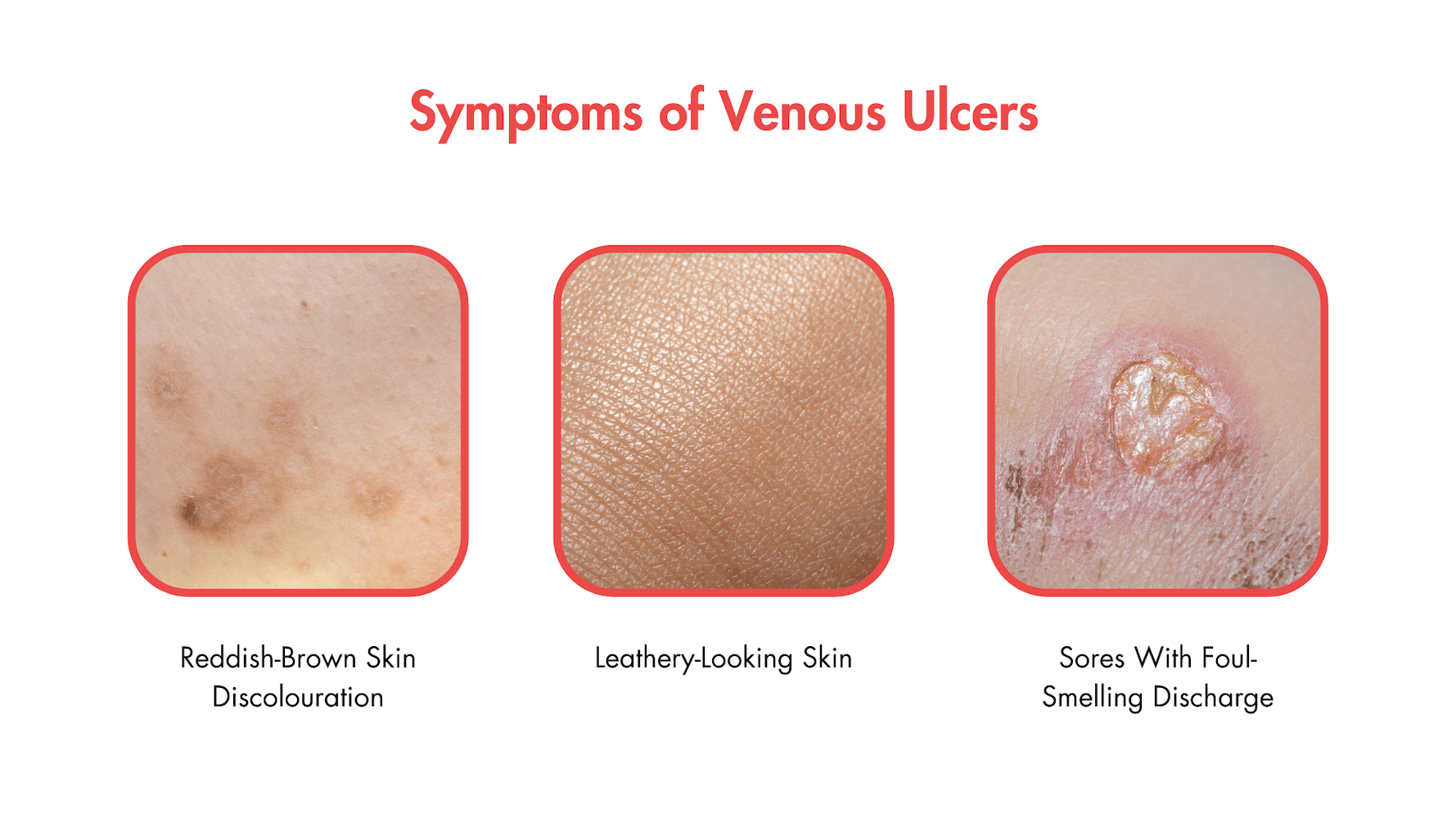 Managing Chronic Venous Insufficiency Symptoms At Every Stage