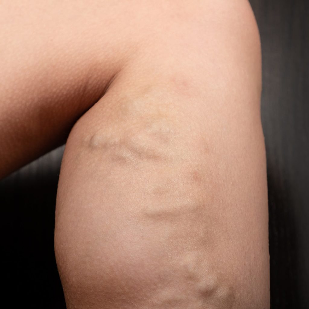 Previous history of DVT