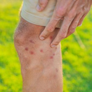 Hyperpigmented Rash Legs Brown Pigmentation on the Legs: Causes and Treatments