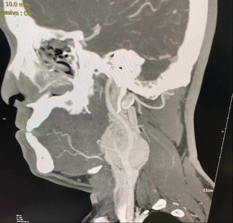 CT scan showing carotid body tumor in the neck copy