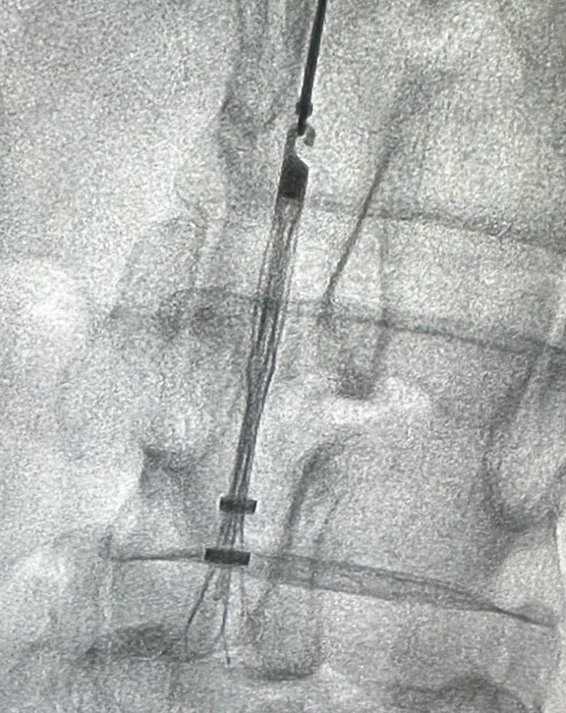 What is an IVC Filter?