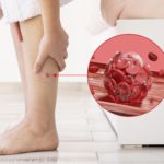 5 Myths About Varicose Veins