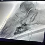 Venous Malformation
