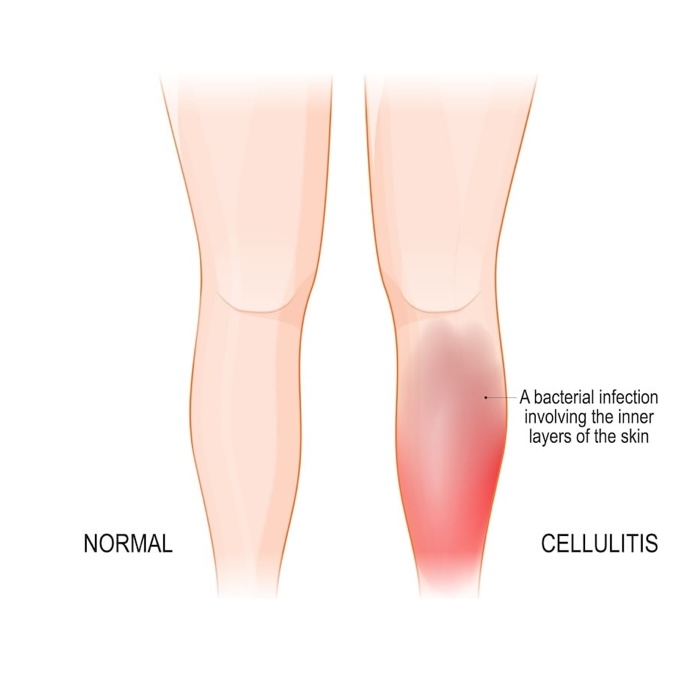Cellulitis Symptoms