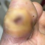 Diabetic Foot Ulcer