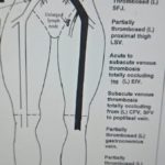 Treat a Deep Vein Thrombosis Surgically