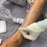 Bleeding From Varicose Veins