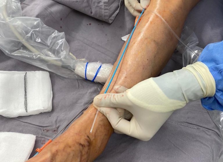 Bleeding From Varicose Veins