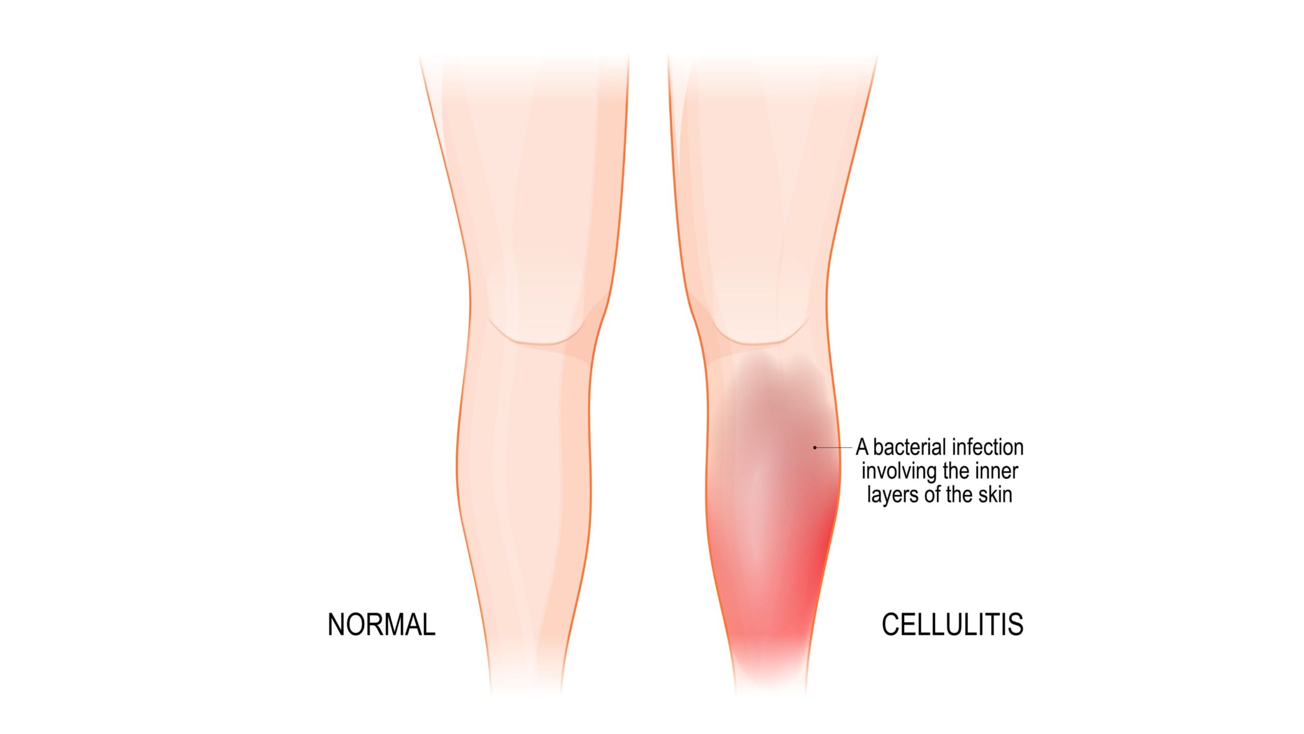 Beyond Chronic Venous Insufficiency: Understanding Cellulitis and When ...