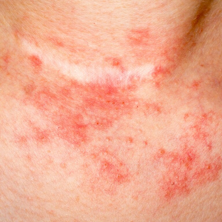 Beyond Chronic Venous Insufficiency: Understanding Cellulitis and When ...