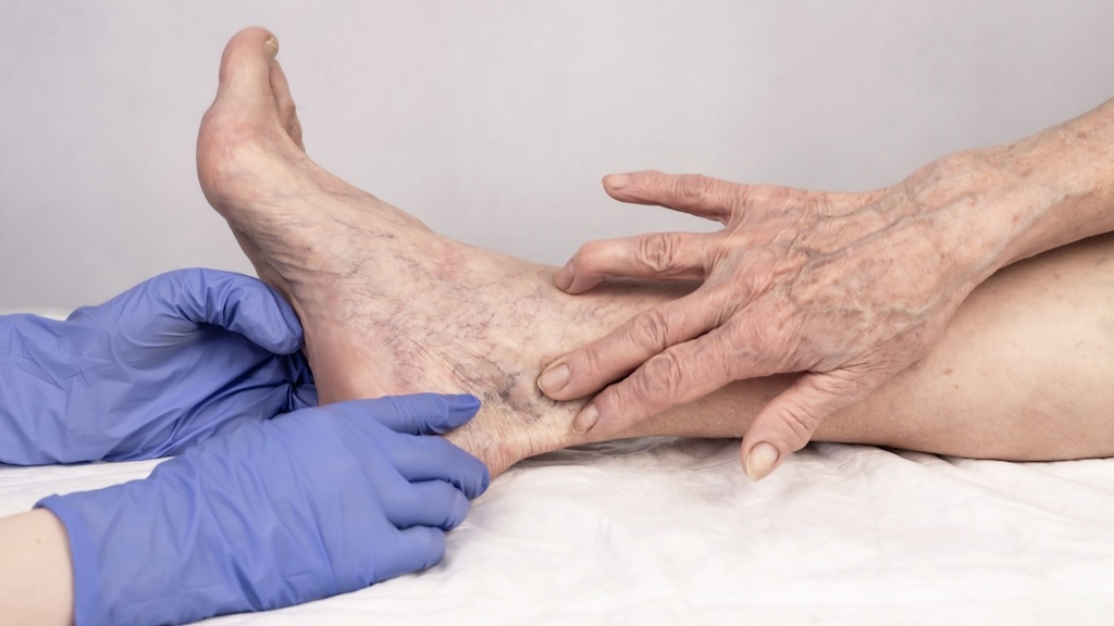 Non-Invasive Procedures for Vascular Aesthetic Concerns