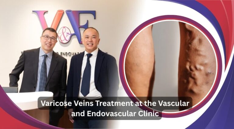 Varicose Veins Treatment at theVascular and Endovascular Clinic